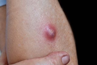 Abscess
