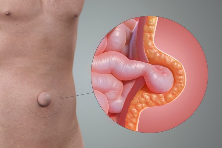 Hernia