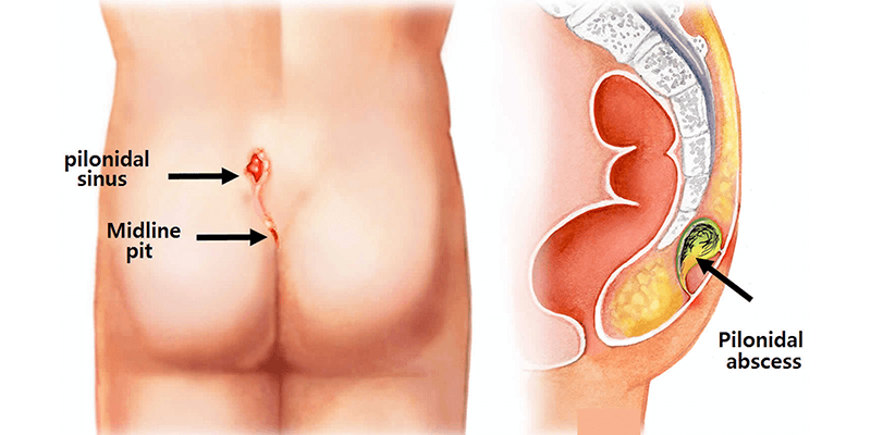 Pilonidal sinus